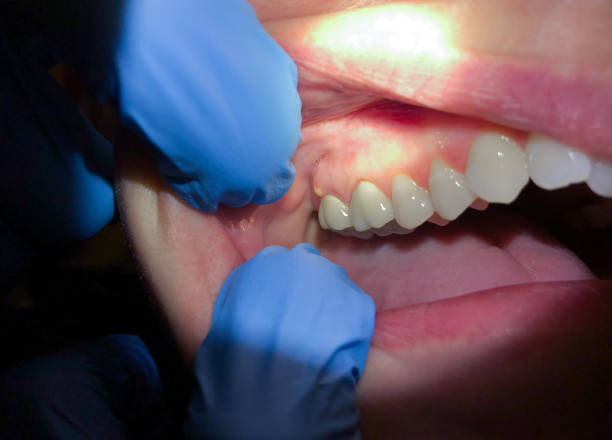 Best Emergency Dental Care for Abscessed Tooth in Carthage, NC